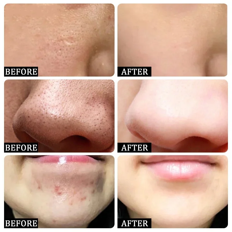 살리실산 모공 클리어링 크림 모공 축소 블랙헤드 제거  - Skincare Salicylic Acid 리뷰 및 가격