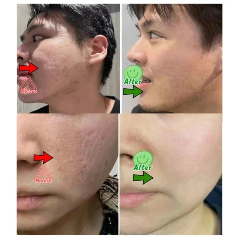 살리실산 모공 클리어링 크림 모공 축소 블랙헤드 제거  - Skincare Salicylic Acid 리뷰 및 가격