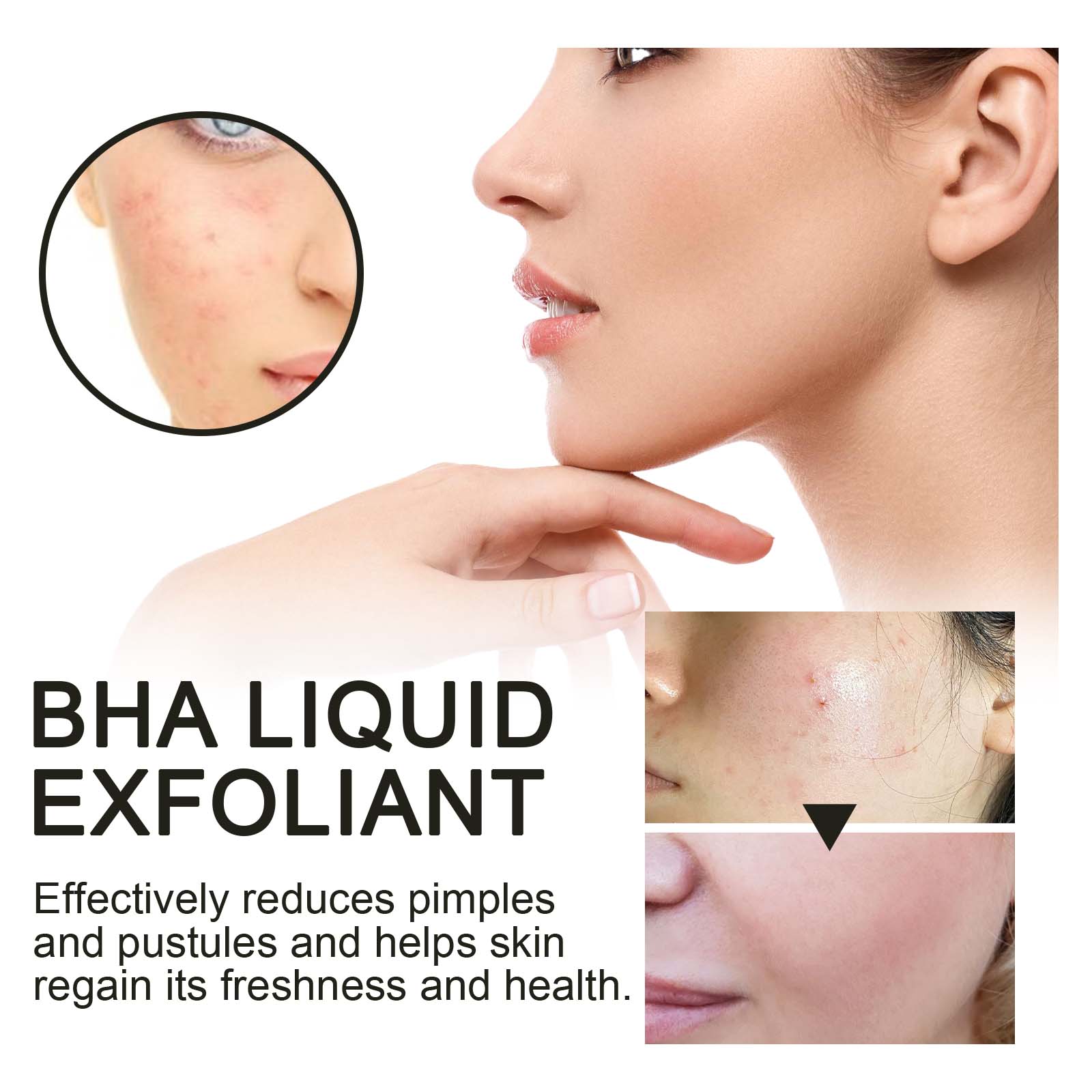 2% 살리실산 액상 각질 제거제 모공 축소 세럼, 확대 - Skincare Salicylic Acid 리뷰 및 가격
